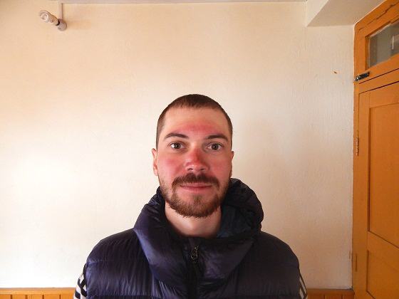 обгорелое лицо